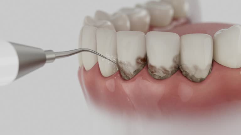Trusted Wisdom Tooth Removal service in Slaughter, LA - Dentist Open Now